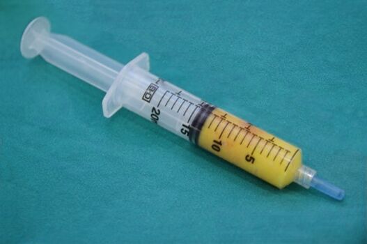 Švirkštas su riebaliniu audiniu lipofilizavimui